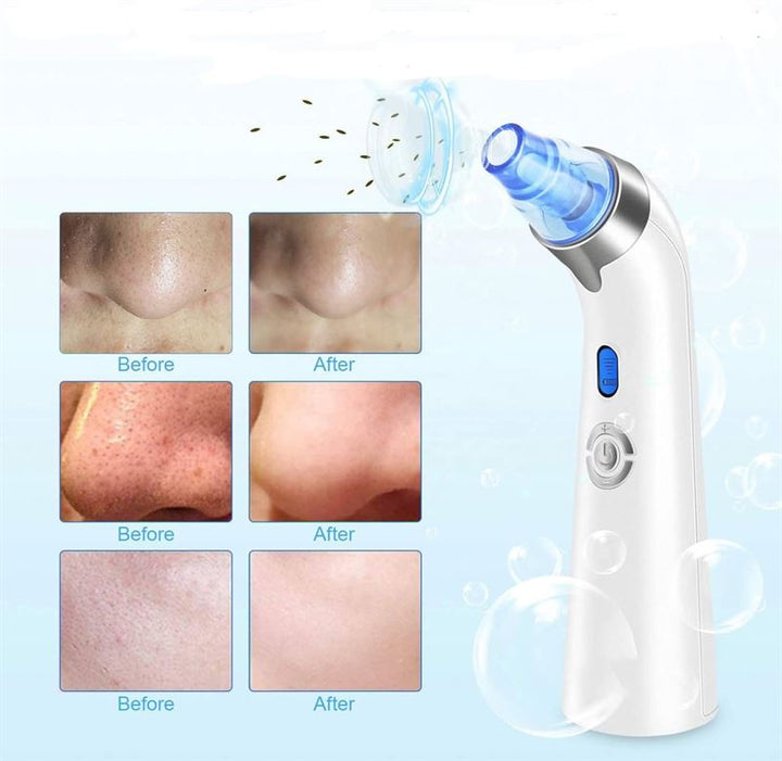 UNIQ Pro Blackhead Remover, Rechargeable Blackhead Remover with LED display - U200 - | Fashiongirl